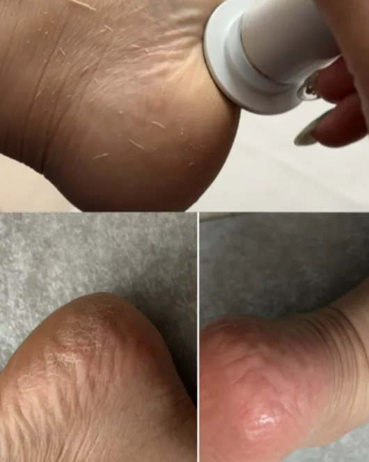手足与足底角质综合护理