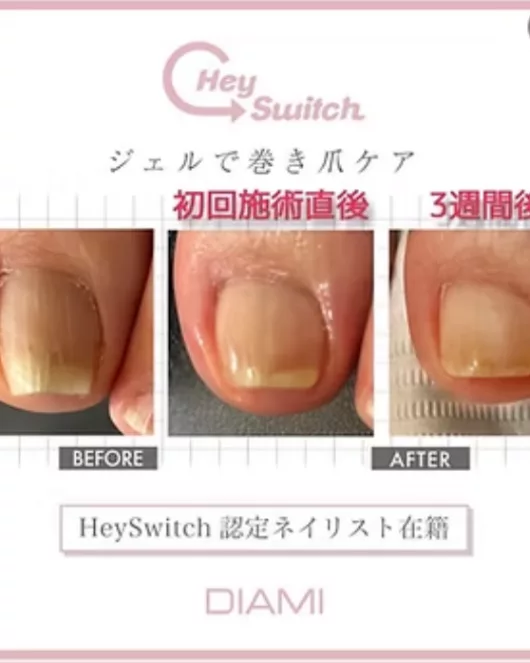 巻き爪ケア